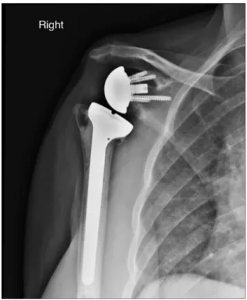 Fig. 3 – Notching: reabsorption of the lower portion of the scapular neck.
