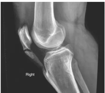 Fig. 4 – Radiological image of the calcification of the patellar tendon.