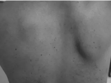 Fig. 3 – Case 2, before the operation. Winged scapula of idiopathic origin.