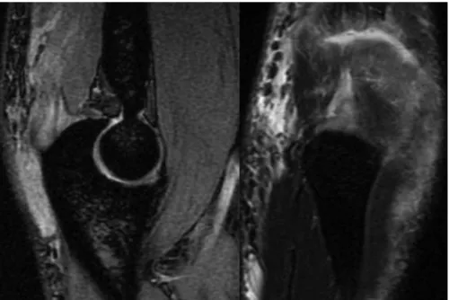 Fig. 1 – Magnetic resonance imaging (sagittal and coronal) showing partial tearing of the tendon of the distal triceps.