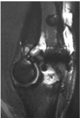 Fig. 4 – Intraoperative imaging showing the final fixation of the tendon to the olecranon.