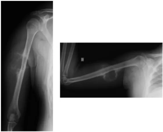 Fig. 1 – Radiographs of the right humerus in anteroposterior and lateral view.