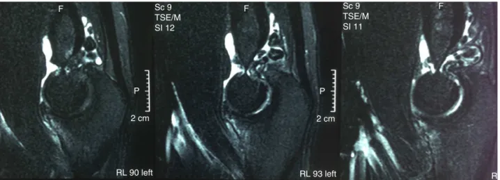 Fig. 1 – T2-weighted sagittal magnetic resonance imaging showing many free bodies in the fossa of the olecranon.
