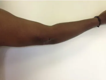 Fig. 8 – Two weeks after the operation, with −20 ◦ of active extension.