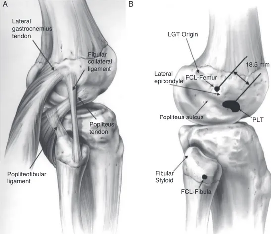 Fig. 1 – Anatomy of the posterolateral corner is represented (A) with the three main structures responsible for lateral side stability: popliteus tendon, popliteofibular ligament and fibular collateral ligament