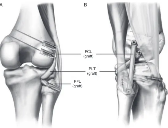 Fig. 2 – Anatomical reconstruction of the posterolateral corner with two free grafts reconstructing the three major