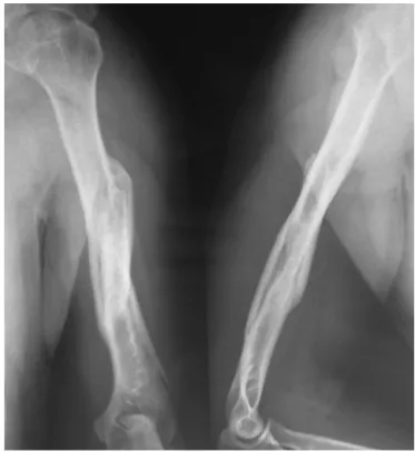 Fig. 3 – Reduction of the fracture and passage of the nail, using an image intensifier.