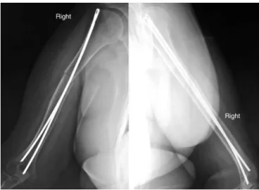 Fig. 5 – Radiographs in anteroposterior and lateral view of the right arm after removal of the nail, with the fracture consolidated.