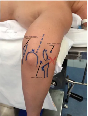 Fig. 1 – Magnetic resonance imaging of coronal section showing a lesion of the short radial extensor tendon.