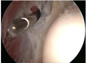 Fig. 4 – Optical device positioned in the proximal