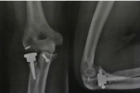 Fig. 1 – Front and lateral-view radiographs of the elbow demonstrating the results from the surgical treatment, with lateral ligament repair using an anchor, radial head prosthesis and osteosynthesis of the coronoid using a screw.