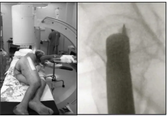 Fig. 2 – Patient positioned in lateral decubitus – lateral radioscopic view of the pelvis.