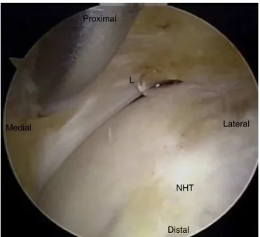 Fig. 2 – Image during operation, after the capsule has been opened, identifying the labrum of the hip (L) and the femoral neck-head transition (NHT).