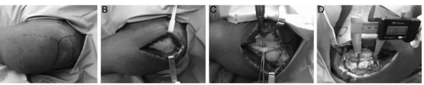 Fig. 1 – Tenotomy procedure on a cadaver. (A) Marking out the bone anatomical parameters and access route; (B) access via anterolateral route; (C) dissection of the LHB from its groove to its origin in the glenoid; (D) measurement of the excursion of the L