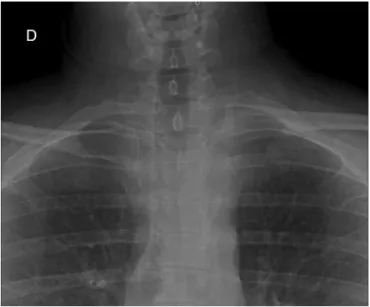 Fig. 3 – Image from computed tomography with 3D reconstruction, showing the displacement of the sternoclavicular joint and bone fragments.