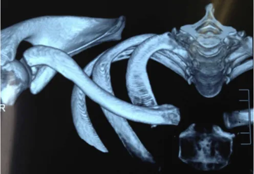 Fig. 4 – Image from computed tomography with 3D reconstruction (view from above), showing the displacement of the sternoclavicular joint.