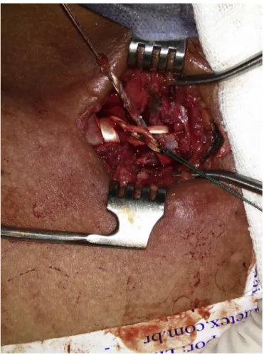 Fig. 8 – After joint reduction, with the graft bound up.