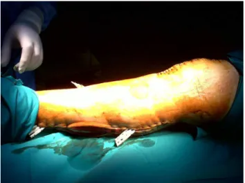 Fig. 4 – Two months after the operation, the patient was still undergoing physiotherapy and the deficits of