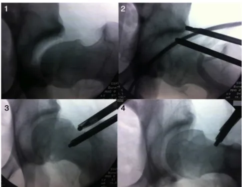 Fig. 1 – Sequence of fluoroscopy images during hip arthroscopy: (1) joint under traction, with the presence of cam and pincer; (2) resection of the pincer; (3) osteochondroplasty of the femoral neck (cam); and (4) final appearance.
