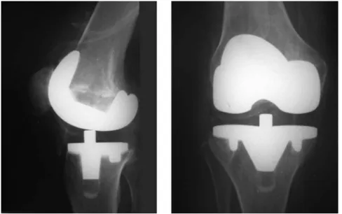 Fig. 1 – Radiographs in anteroposterior (AP) and lateral views on a knee that underwent total arthroplasty with mobile tibial weight-bearing.