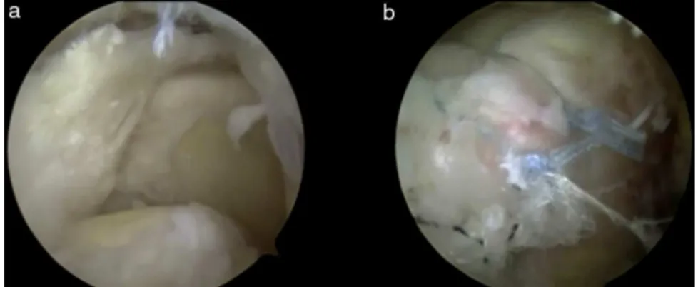 Fig. 1 – Intraoperative image of the right shoulder viewed through the posterior portal, showing: (A) lesion of the tendon of the supraspinatus and infraspinatus, which are greatly degenerated; (B) closure of the lesion using tendon-to-tendon stitches and 