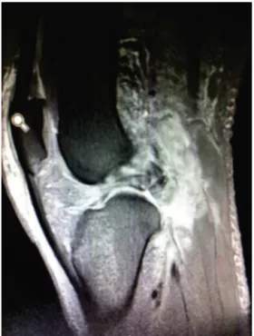 Fig. 1 – Appearance of the limb with posterior fall of the tibia.