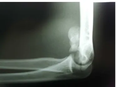 Fig. 1 – Anteroposterior radiographic view, which does not show the fracture pattern clearly.