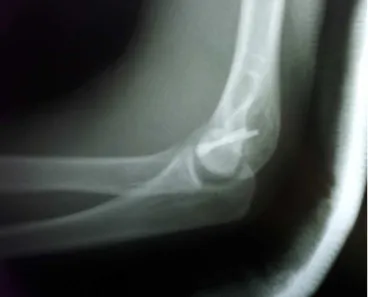 Fig. 6 – Lateral radiographic view showing positioning of the synthesis material and anatomical reduction of the joint surface.