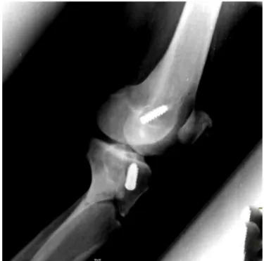 Fig. 1 – Frontal radiograph on knee showing fracture of proximal tibia.