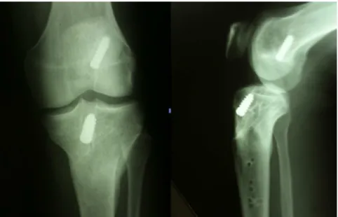 Fig. 5 – Twelve months after operation, after removal of synthesis material.