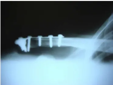 Fig. 2 – Fixation using T plate in anatomical model, in view from above.