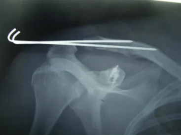 Fig. 6 – Final radiograph by the technique using anchors and Kirschner wires.
