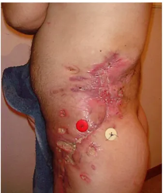 Fig. 6 – Attempt to bring together the edges of the wound, before constructing myocutaneous flaps.