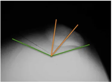 Fig. 3 – Radiograph of the knee in axial view. Note the trochlear dysplasia and lateralization of the patella.
