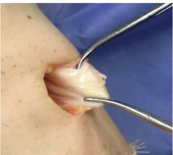 Fig. 5 – Identification of the semitendinosus and gracilis tendons.