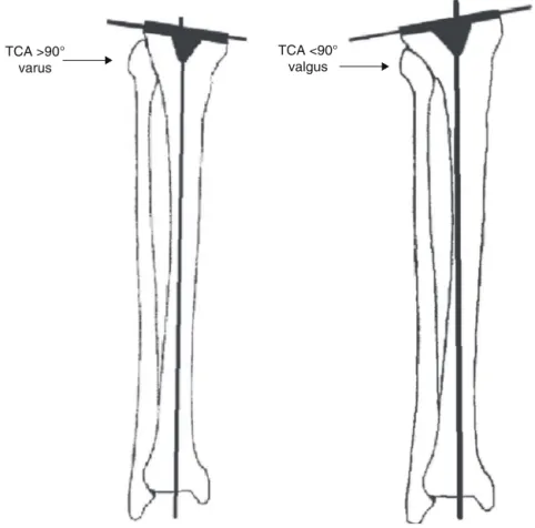 Fig. 3 – Tibial component angle (TCA) &gt; 90 ◦ : varus. Tibial component angle (TCA) &lt; 90 ◦ : valgus.