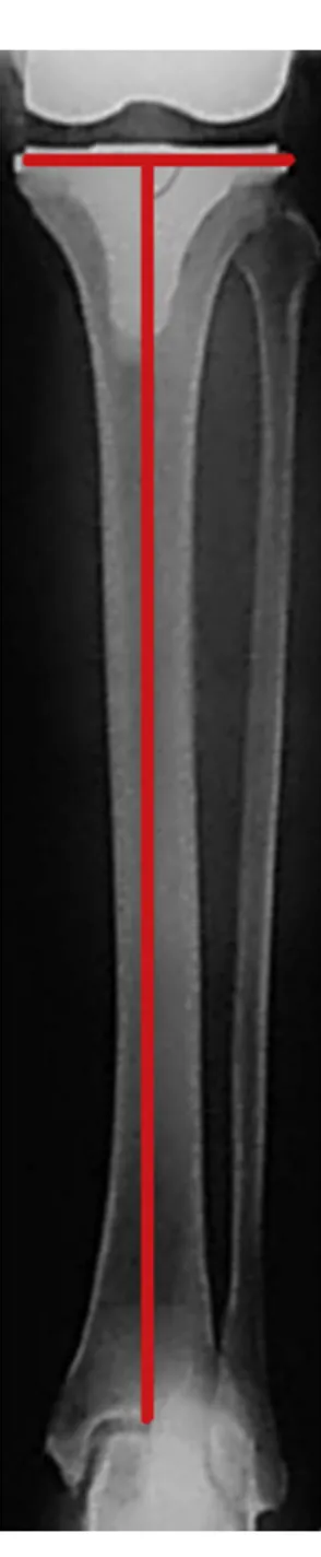 Fig. 4 – Tibial component angle (TCA) measured on a postoperative radiograph.
