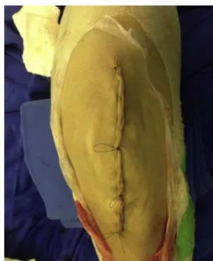Fig. 7 – Plasma being removed.