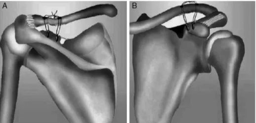 Fig. 1 – Schematic drawing demonstrating the positioning of the anchors and holes drilled in the clavicle, in (A) posterior view and (B) anterior view.
