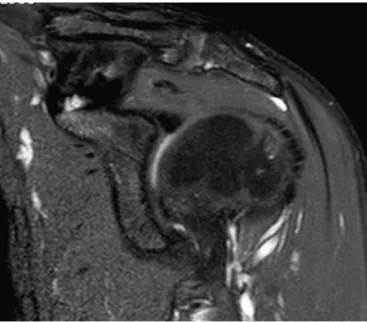 Fig. 2 – MRI using the standards described for viewing the coracoclavicular ligaments of a patient who underwent surgical treatment for ACD.