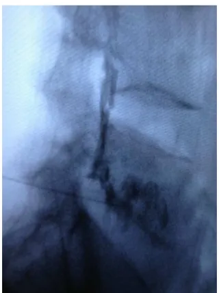Fig. 1 – Transforaminal block. Image obtained via fluoroscopy.