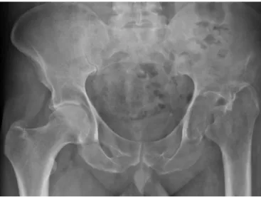 Fig. 1 – X-ray of the pelvis, with weight bearing (AP view).