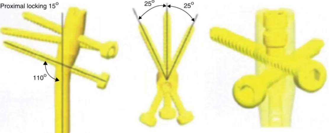 Fig. 1 – Schematic drawing of the intramedullary metaphyseal nail with proximal locking and angular stabilization.