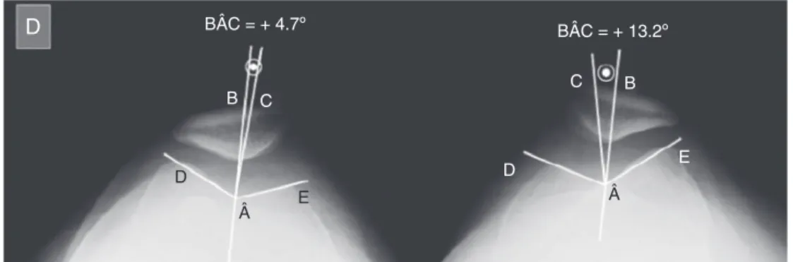 Fig. 2 – Merchant’s patellar congruence angle (BÂC). Line C bisects the angle DÂE, which is the angle of the trochlear sulcus.
