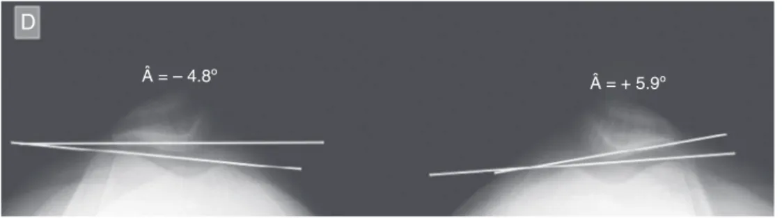 Fig. 8 – Negative lateral inclination angle (Â) of the patella (Â = −4.8 ◦ ) in the right knee with ACL injury and positive angle (Â = +5.9 ◦ ) in the normal left knee.