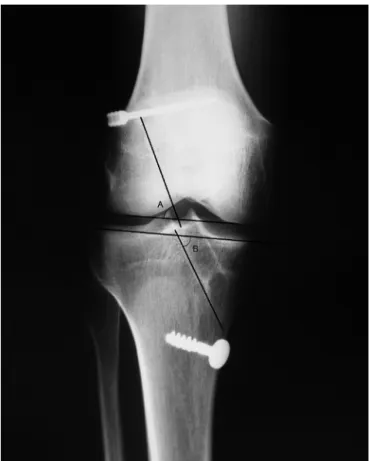 Table 3 – Distribution of patients into groups according to anteroposterior radiography (coronal plane).