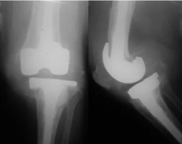 Fig. 2 – Transoperative clinical image of revision of the arthroplasty of the left knee, demonstrating osteolysis in the medial tibial metaphysis.