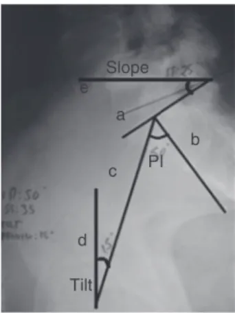 Fig. 1 – Measurement of PT, SS, and PI. PT, pelvic tilt; SS, sacral slope; PI, pelvic incidence