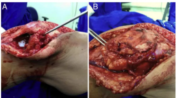 Fig. 1 – Illustration of the surgical technique using Keblish’s access route, demonstrating the Hoffa fat flap needed for closure without tension of the joint capsule
