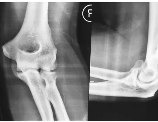 Fig. 2 – Radiograph in AP and lateral views showing the radial head fracture and anterior displacement of the fragment.